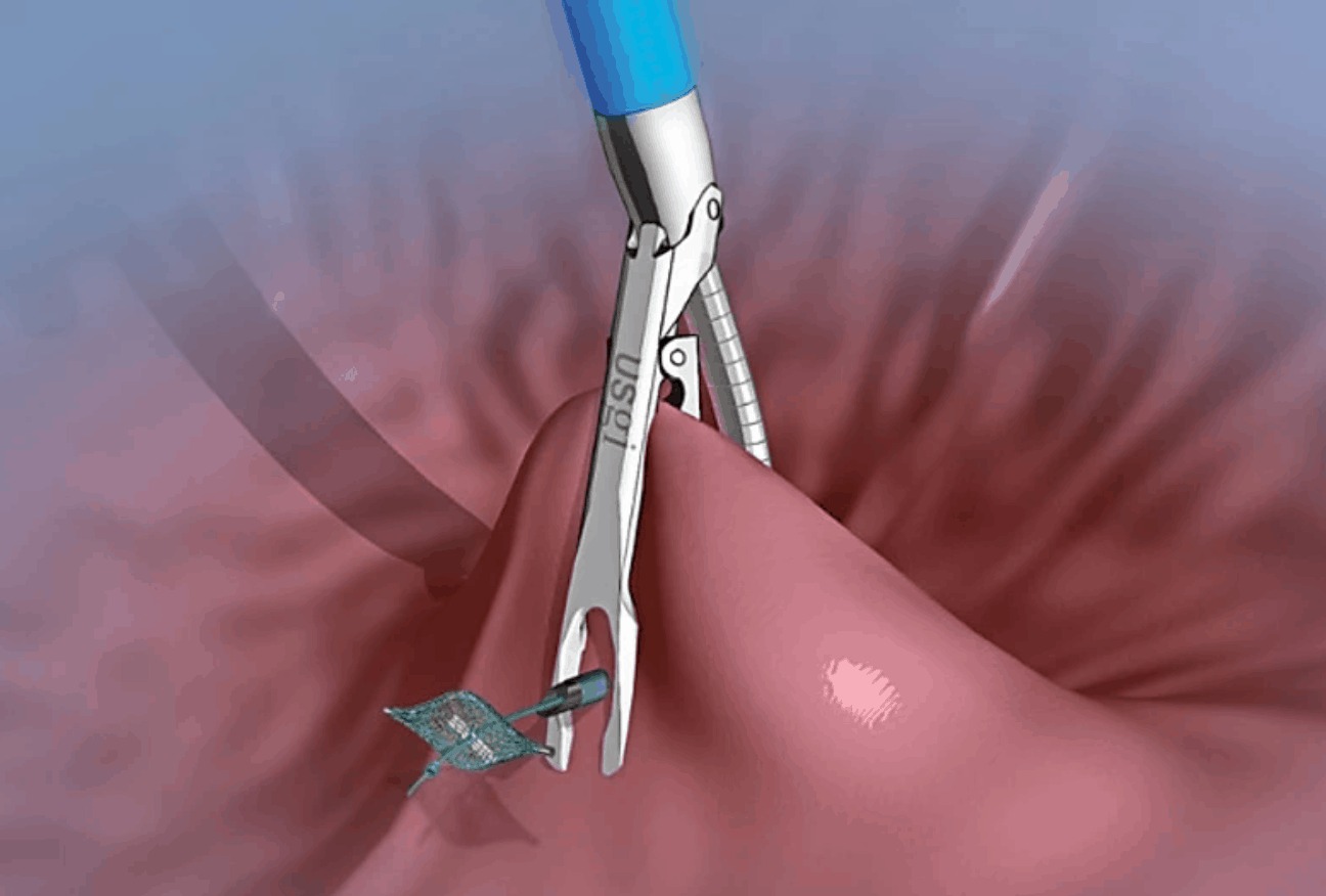 Magenverkleinerung Türkei: Sicher abnehmen mit Dr. Volkan Arayıcı in der führenden Adipositas Klinik